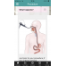 Gastric Sleeve - Endoscopic